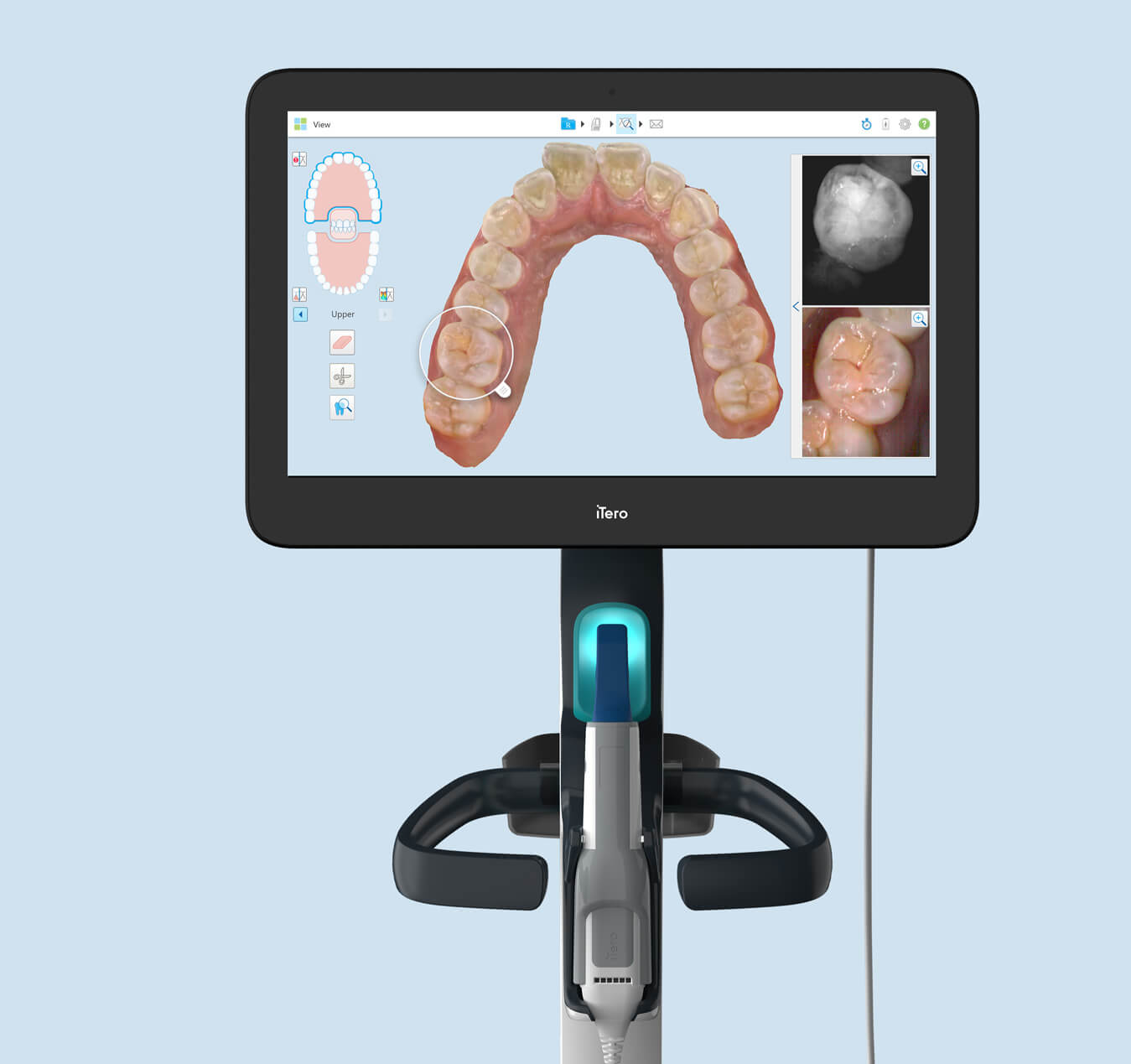 Benefits of the iTero digital scanner