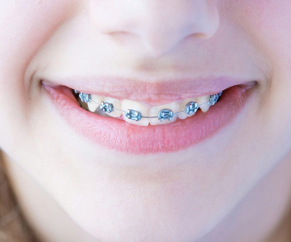 What are Fixed braces / Train tracks?